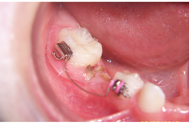 I denti da latte I denti da latte